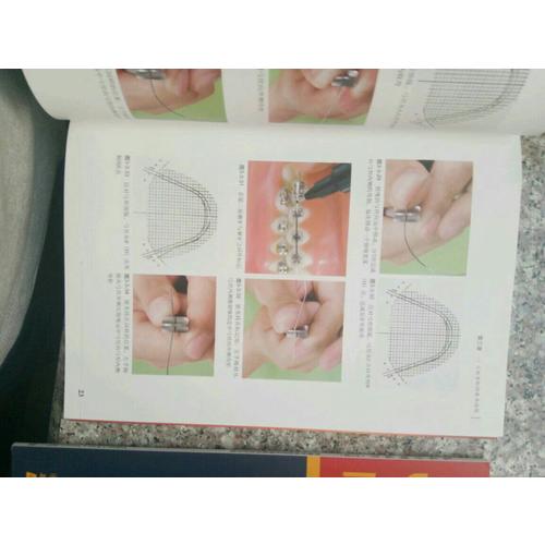 混合牙列期咬合诱导