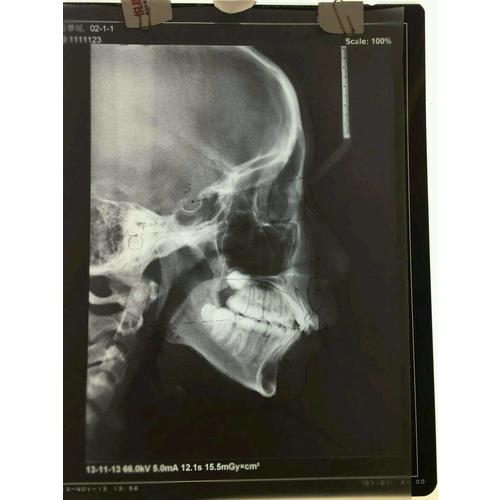 混合牙列期咬合诱导