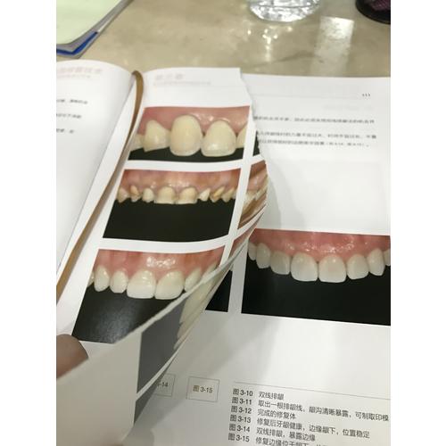 瓷贴面修复技术·从标准到微创无预备